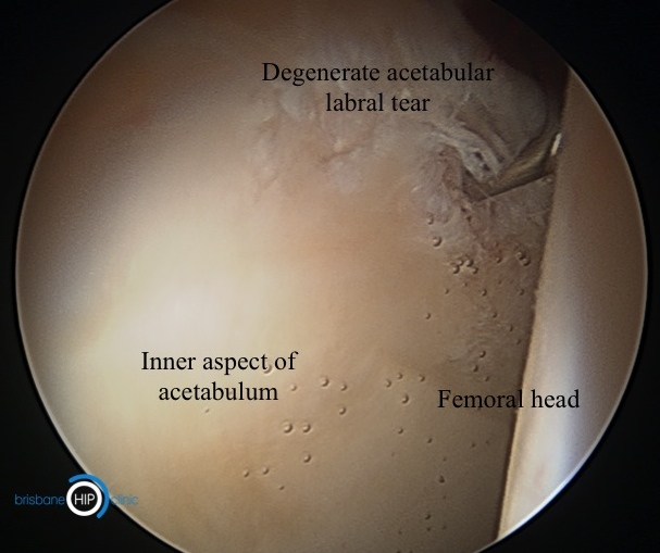 Hip Joint Labral Tear