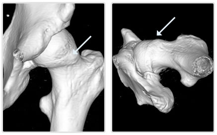 Impingement (FAI) - Brisbane Hip Clinic Australia