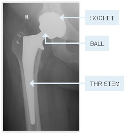 What is a Total Hip Replacement? - Brisbane Physiotherapy